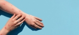 New Monkeypox Case Found in San Diego County As Officials Await CDC Confirmation