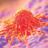 Valley fever, historically found only in the Southwest, is spreading. It can have devastating consequences.