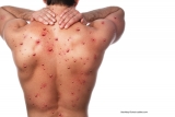 World Health Network Declares Monkeypox Outbreak a Pandemic