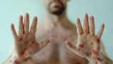 CDC Warns of Severe Monkeypox in People With HIV, the Immunocompromised