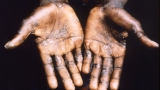 Dr. Scott Gottlieb says rising monkeypox cases suggest its spread ‘pretty wide’