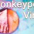 Monkeypox: World Health Organisation says diseases will 'continue to emerge' – Sky News