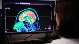 Why there’s excitement and skepticism about new Alzheimer’s drug lecanemab