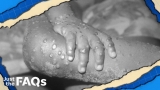 Monkeypox cases may be mistaken for a sexual transmitted disease: CDC