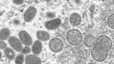 Renaming monkeypox: World Health Organization plans to rename virus over stigmatization concerns
