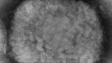 Marin County confirms 2 new monkeypox cases as CDC addresses data, concerns nationally