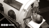 Polio: Do we have to worry about it once again? – BBC