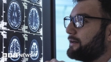 Alzheimer’s drug lecanemab hailed as momentous breakthrough