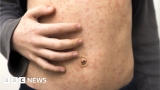 Ohio reports more measles cases than previous two years combined