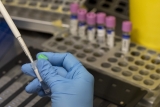 CDC widens net of monkeypox symptoms for clinicians to watch for as cases continue to rise