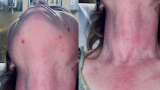 Arkansas woman shares rare reaction to COVID-19 vaccine, still advocates for it – KATV