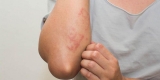 Living Review Compares Treatments for Atopic Dermatitis – Consumer Health News