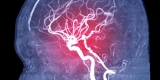 Meds, Exercise Recommended for Stroke Prevention After sICAS – Consumer Health News
