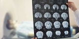 Neuroimaging Use in Ischemic Stroke Examined for Medicare Patients – Consumer Health News