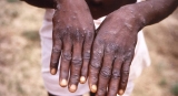 Animal-to-human diseases on the rise in Africa, warns UN health agency |