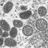 CDC issues new report on severe, unusual hepatitis in kids
