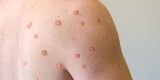 U.S. Monkeypox Cases Now at 21, Two Strains Identified – Consumer Health News