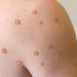 Florida Department of Health, CDC investigating a presumptive case of monkeypox