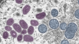 U.S. buys 300,000 more monkeypox vaccine doses