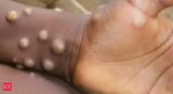 Monkeypox is a global public health emergency, WHO triggers highest alert – The Economic Times Video