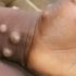 Michigan creates monkeypox website as CDC says the vaccine supply falls far short of demand