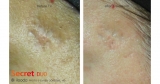 ilooda’s Medical Device Wins FDA Approval for Treating Scars After Monkeypox