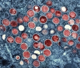 Monkeypox cases increasing in San Antonio, risk remains low