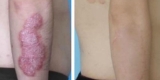 Nerve Block Plus Lidocaine Clears Psoriasis in Small Study – Consumer Health News