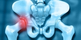 Increased CXCL9 Level Linked to Increased Hip Fracture Risk in Men – Consumer Health News