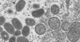 Second person in the U.S. dies after contracting monkeypox