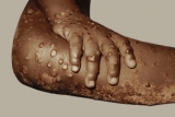 CDC Monitors Potential Monkeypox Exposure in U.S.