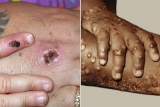Should We Be Worried About Monkeypox?