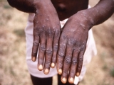 Health News Roundup: Massachusetts identifies first 2022 U.S. case of monkeypox infection; Explainer-Why monkeypox cases are spreading in Europe, US and more