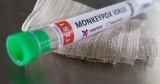 US monkeypox cases may have gone undetected, health official says | Health News