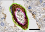 Small NIH study reveals how immune response triggered by COVID-19 may damage the brain
