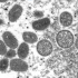 Monkeypox outbreak: Fauci says ‘never blow off any emerging infection’