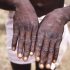 Overdose death rates increased significantly for Black, American Indian/Alaska Native people in 2020 | CDC Online Newsroom