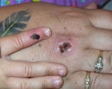 Is monkeypox a world health emergency? The WHO will decide next week.