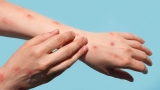 CDC Says We Probably Can’t Get Rid of Monkeypox Now