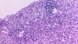 Study seeks to provide clues to seeming surge of hepatitis cases in kids