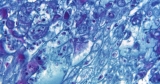 County identifies additional monkeypox case