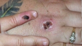 Monkeypox: CDC and Massachusetts health officials investigating a case