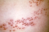 CDC’s ACIP recommends Shingrix for immunocompromised adults aged 19+