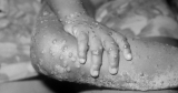 How do you get it and what are the symptoms?