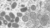 Monkeypox: CDC monitors 6 people in US for possible rare infection, says public ‘should not be concerned’