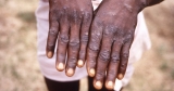 As monkeypox outbreak swells, experts offer guesses as to why Europe has seen unprecedented spread