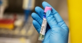 CDC issues new guidance on monkeypox symptoms as U.S. cases rise