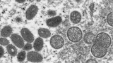 Monkeypox: WHO to consider again whether outbreak is public health emergency of international concern