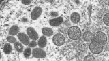 Monkeypox may spread before symptoms start, study suggests