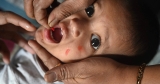 Measles now an imminent global threat due to pandemic, WHO and CDC say